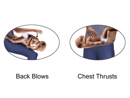 11. Heimlich manoeuvre in infants