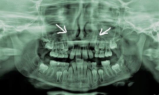 5. X-ray photo of unerupted canines