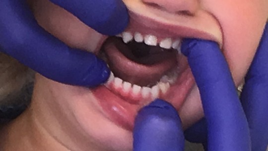 7. Milk set of teeth