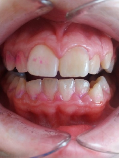 1. Dental plaque