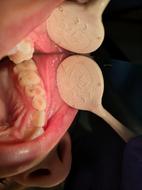 7. Erosion in a nine-year-old patient with oesophageal reflux