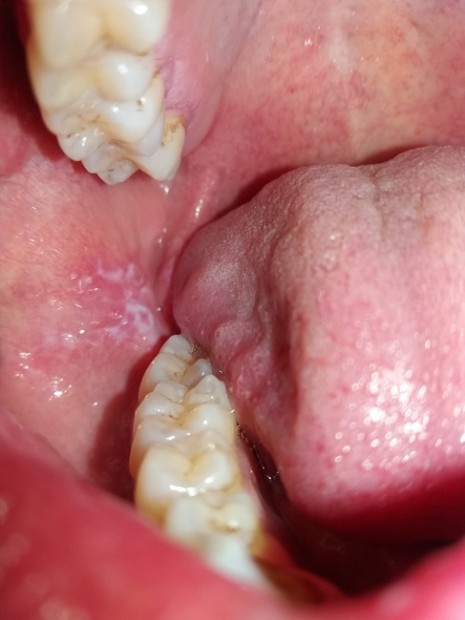 12. Leukoplakia