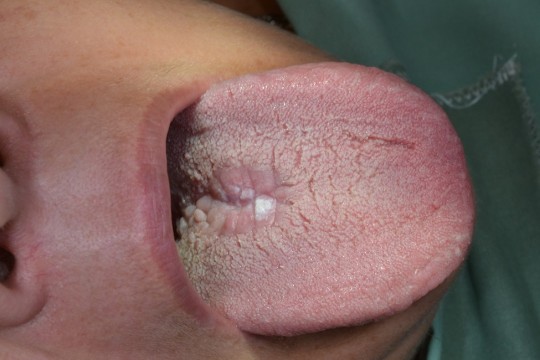 14. Median rhomboid glossitis