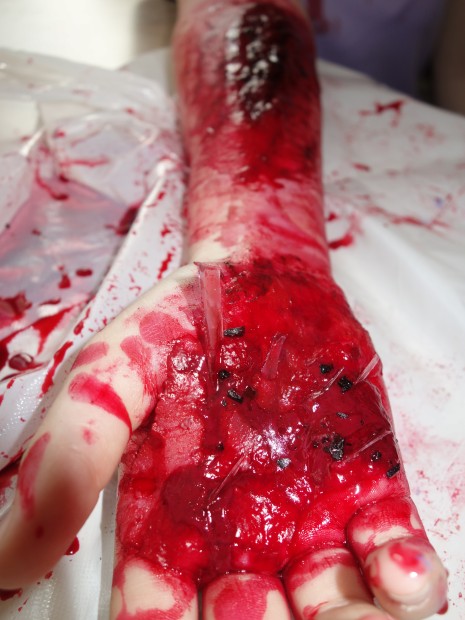 18. Rána s cizím tělesem na dlani