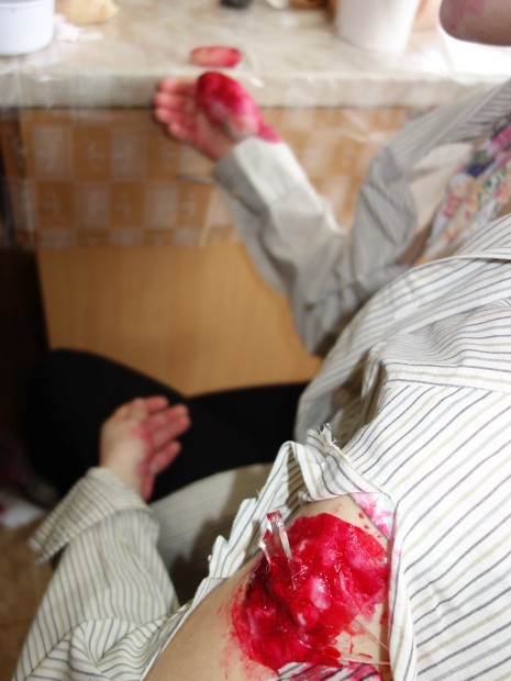 19. Rána s cizím tělesem v rameni