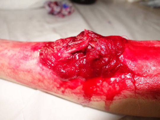 20. Zevní krvácení