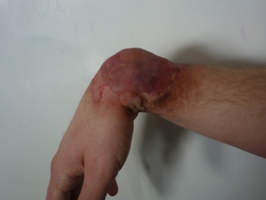 21. Zavřená zlomenina