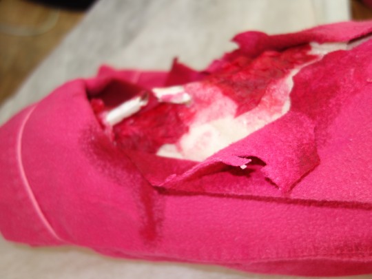 22. Otevřená zlomenina holenní kosti