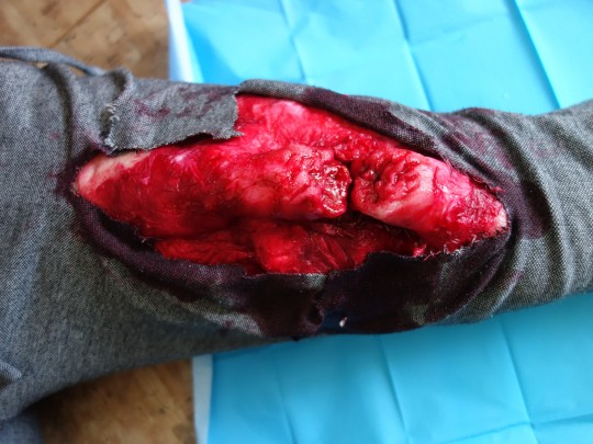 23. Otevřená zlomenina stehenní kosti