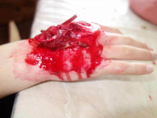 24. Otevřená zlomenina záprstních kůstek