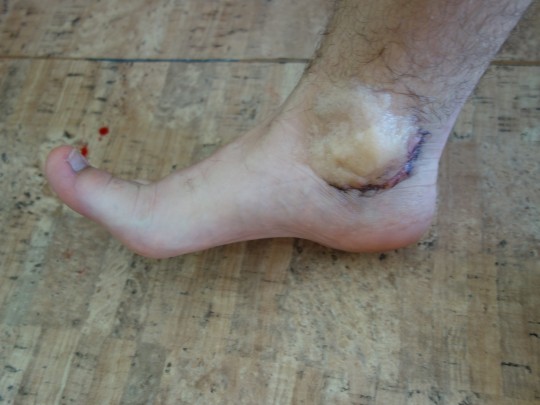 25. Podvrtnutí = distorze kotníku