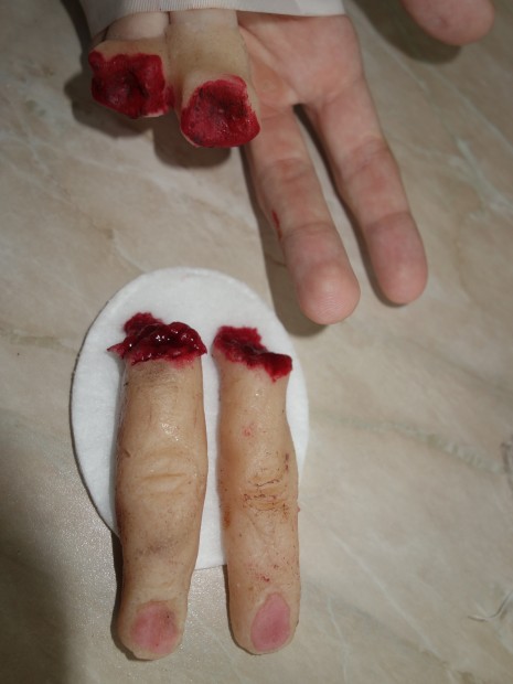 26. Ztrátová poranění prsteníku a malíčku