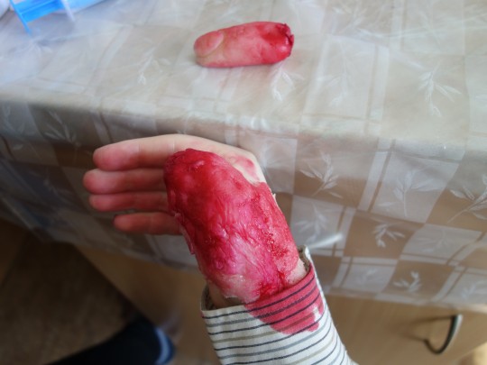 27. Ztrátová poranění palce na horní končetině