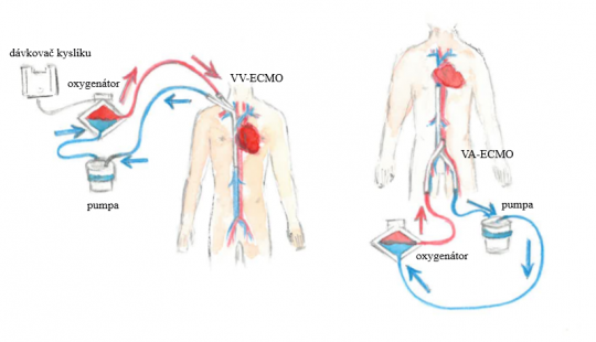 2. ECMO