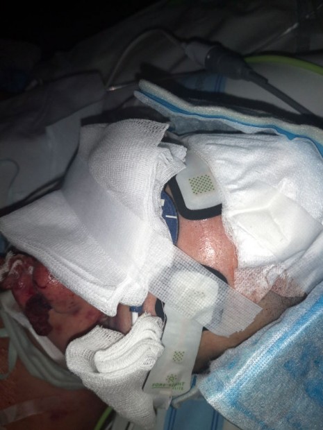 26. Monitoring pacienta s kraniotraumatem