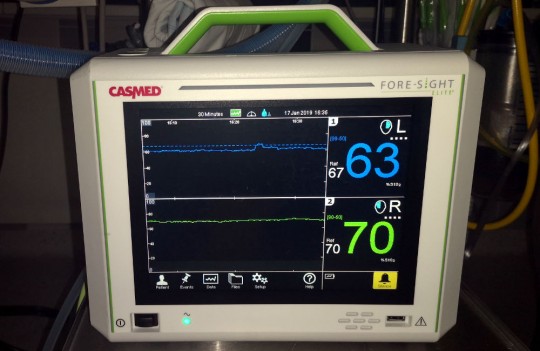 27. Monitor pro sledování transkraniální kapilární saturace v mozkové tkáni