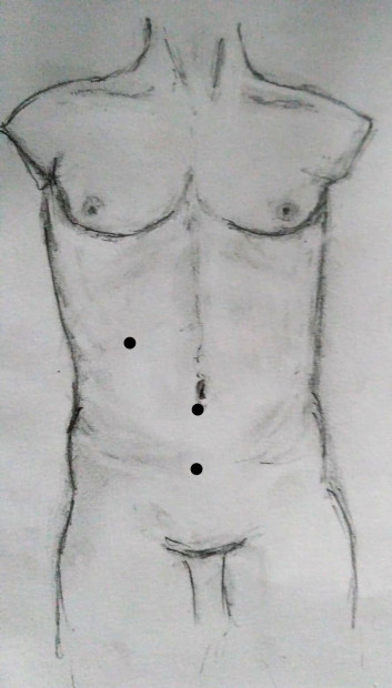 1. Laparoskopický přístup k apendixu