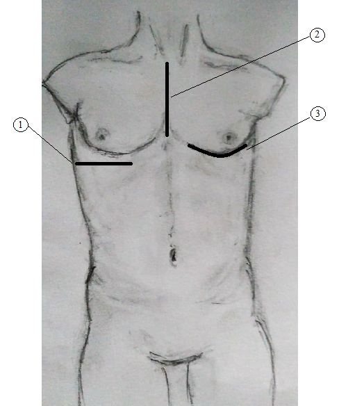 1. torakotomie laterální, 2. sternotomie, 3. torakotomie přední [2]
