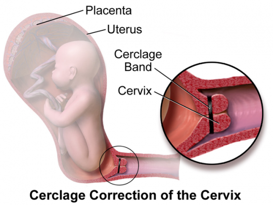 Cerclage