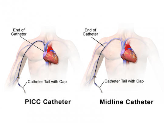 3. PICC, Midline katetr