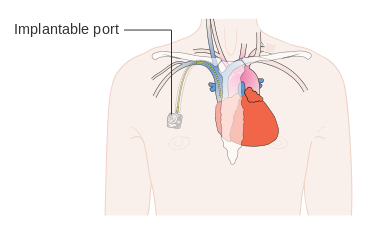4. Implantabilní intravenozní port