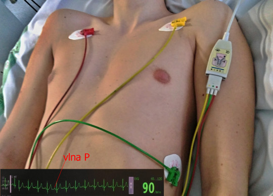 6. Elektrody EKG