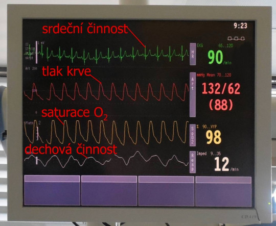 Na obrázku vidíme kontinuální sledování EKG jako zelenou křivku, kdy HR (tep) za minutu je 90.