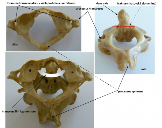 12. Krční obratle – atlas, axis