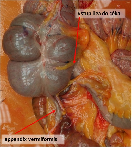 93. Ileocékální oblast a appendix vermiformis