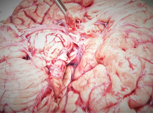 105. Spodina mozku – pinzetou uchopena hypofýza