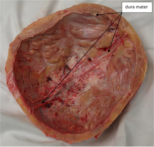 133. Tvrdá plena – dura mater
