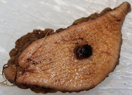 24. Maligní melanom (fixace ve formaldehydu).