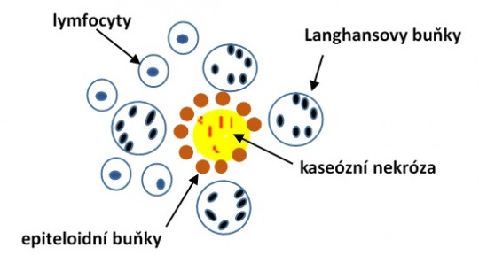 20. Tuberkulózní uzlík.
