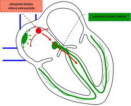 28. Poruchy srdečního rytmu – síňová extrasystola.