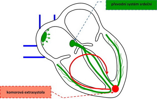 29. Poruchy srdečního rytmu – komorová extrasystola.
