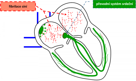 31. Poruchy srdečního rytmu – fibrilace síní.