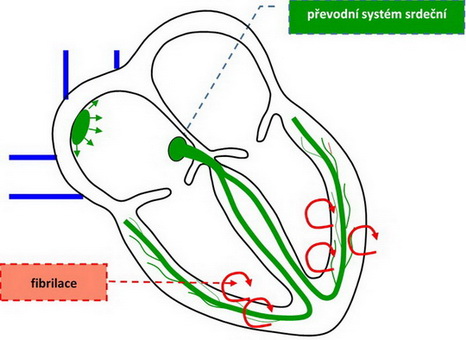 33. Poruchy srdečního rytmu – fibrilace komor.