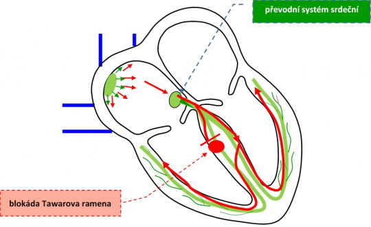 34. Poruchy srdečního rytmu – blokáda Tawarova ramena.