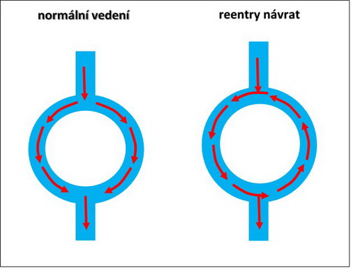 35. Poruchy srdečního rytmu – normální vedení a reentry návrat.