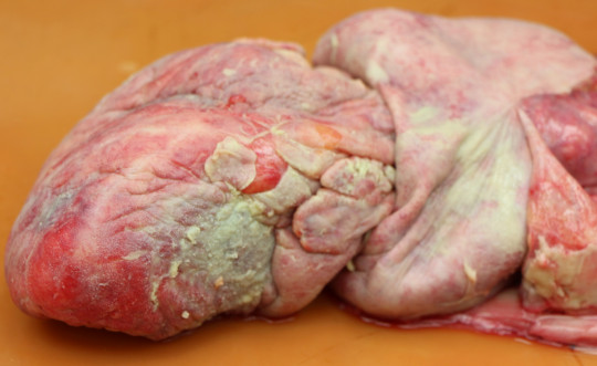 36. Hnisavá pericarditis.