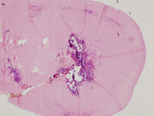 38. Histologický preparát – aterom a dystrofická kalcifikace.