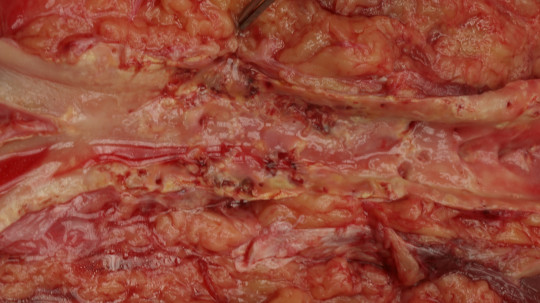 39. Ateroskleróza aorty (v oblasti bifurkace aorty).