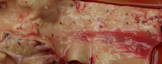 40. Odstup mezižeberních tepen hrudní aorty a ateroskleróza.