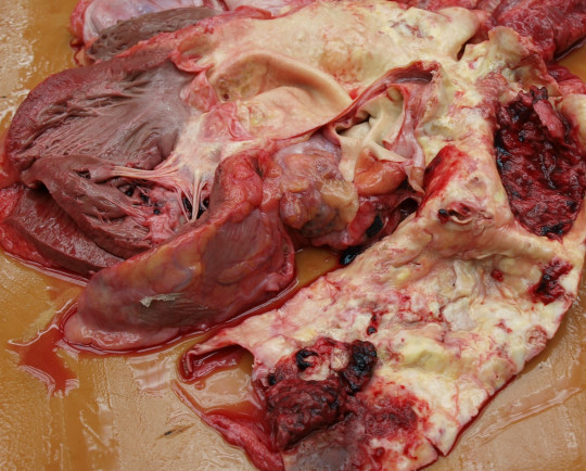 41. Ateroskleróza s rupturou aneuryzmatu.