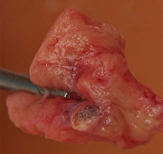 42. Uzávěr koronární tepny.