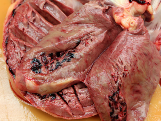 43. Infarkt myokardu s rupturou.