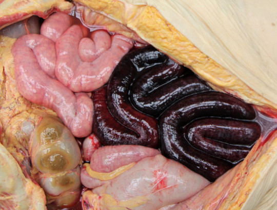 44. Hemorhagická infarzace střeva.
