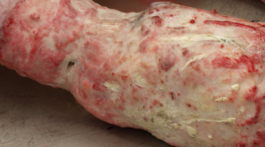 45. Trofický vřed.