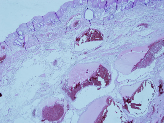 46. Histologický preparát – hemoroidy.
