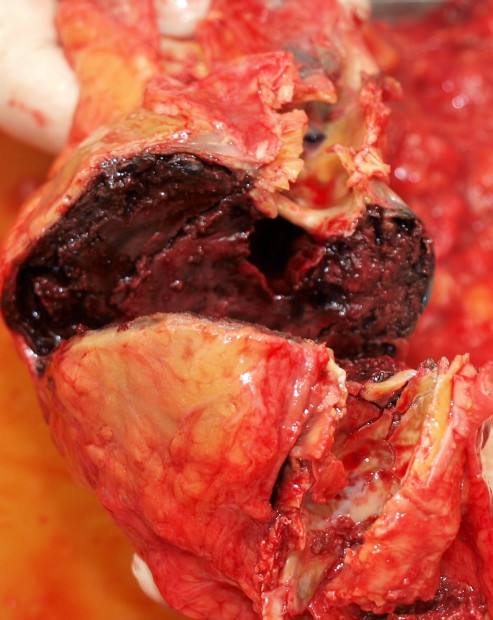 47. Trombozované aneuryzma aorty.